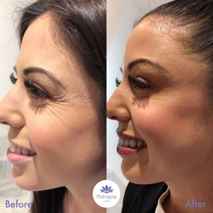 Before anti-wrinkle injections and after anti-wrinkle injections treatment, another happy customer happy with her results