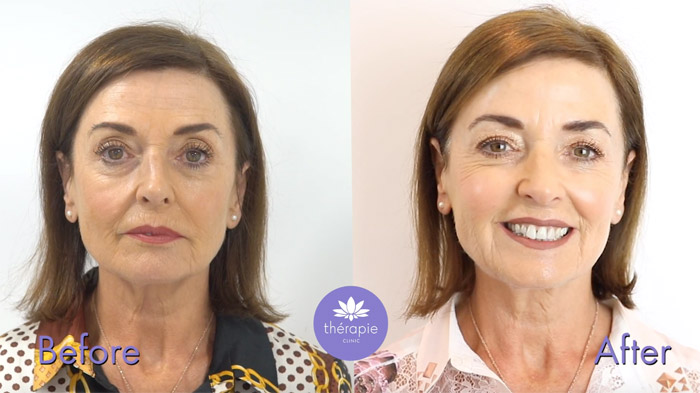 Our client is happy with the results of dermal fillers and Botox which resulted in fresher look and having to wear less make up to show off a beautiful, natural looking skin 