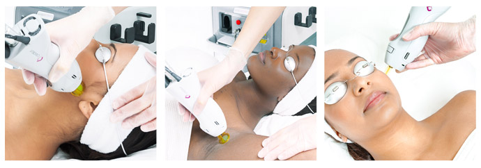 laser-hair-removal-dark-skin-tones-therapie