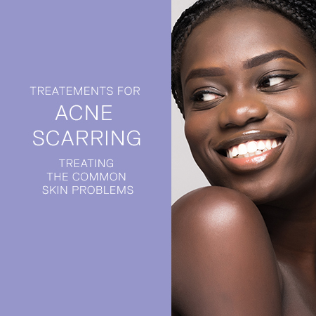 acne scarring banner