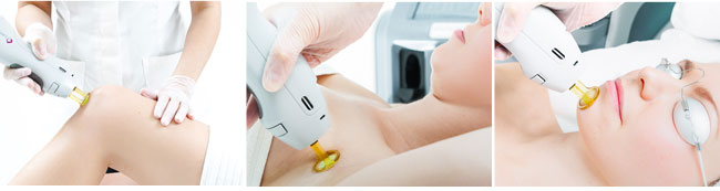 therapie-laser-hair-removal-technology