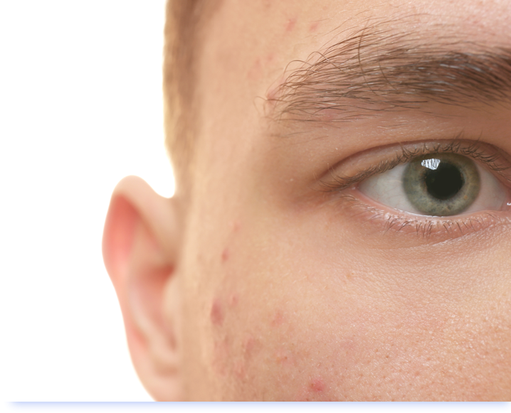 ACNE SCARRING